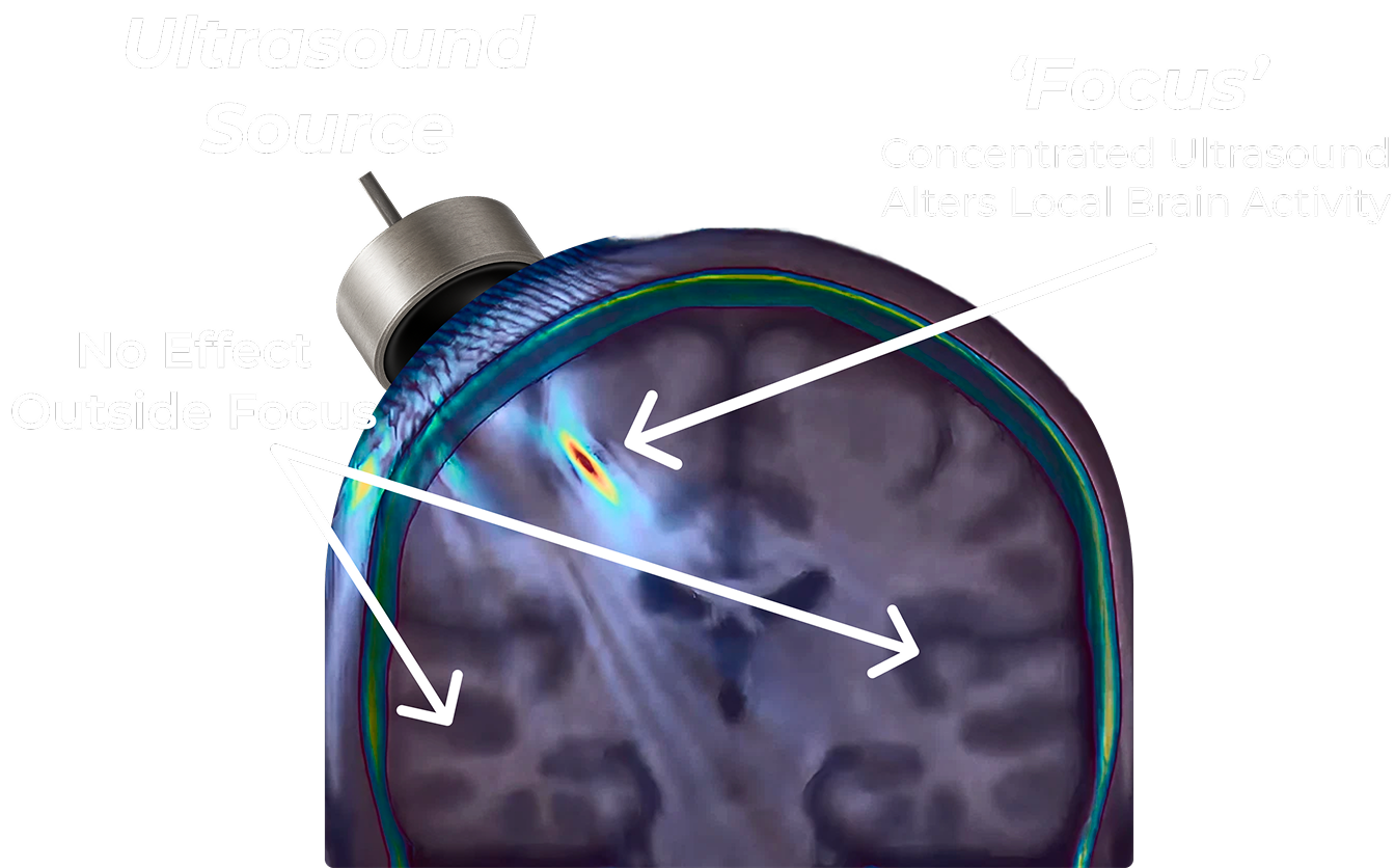 Neuromodulation preview
