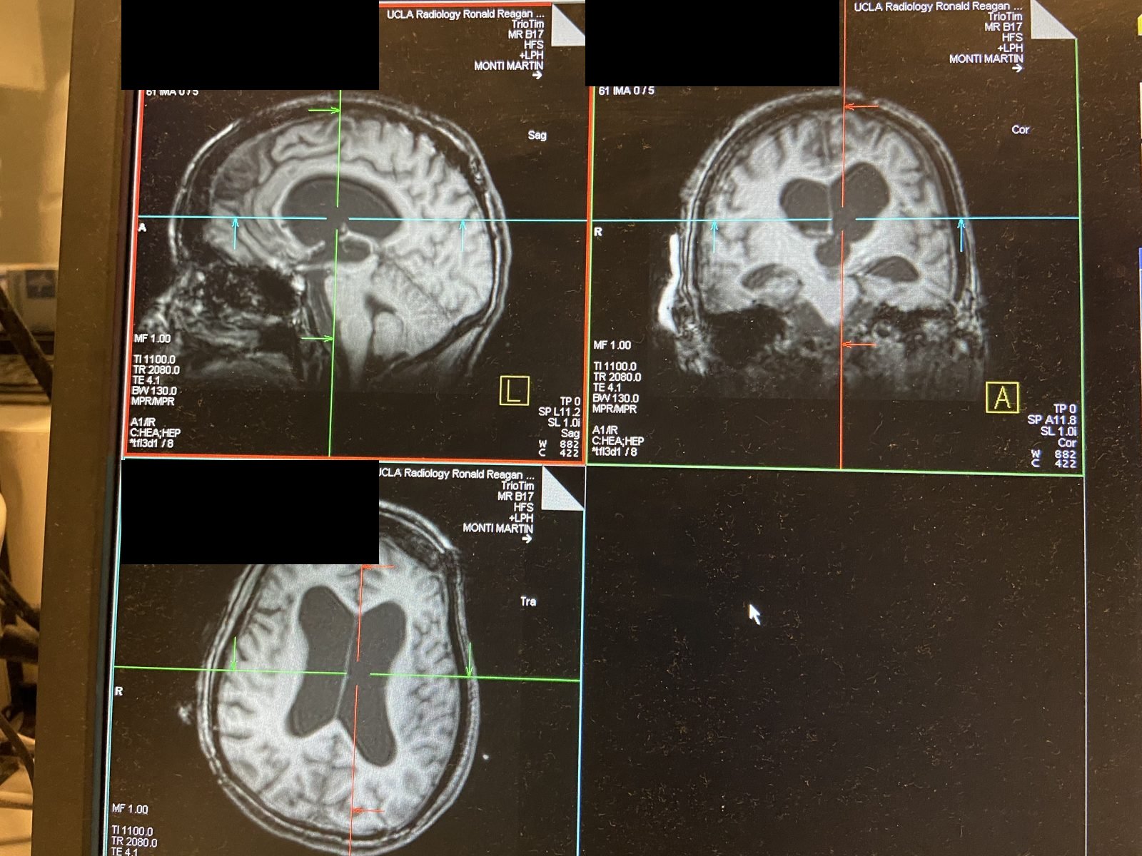 MRI console — sagittal, coronal and axial structural views (de-identified)