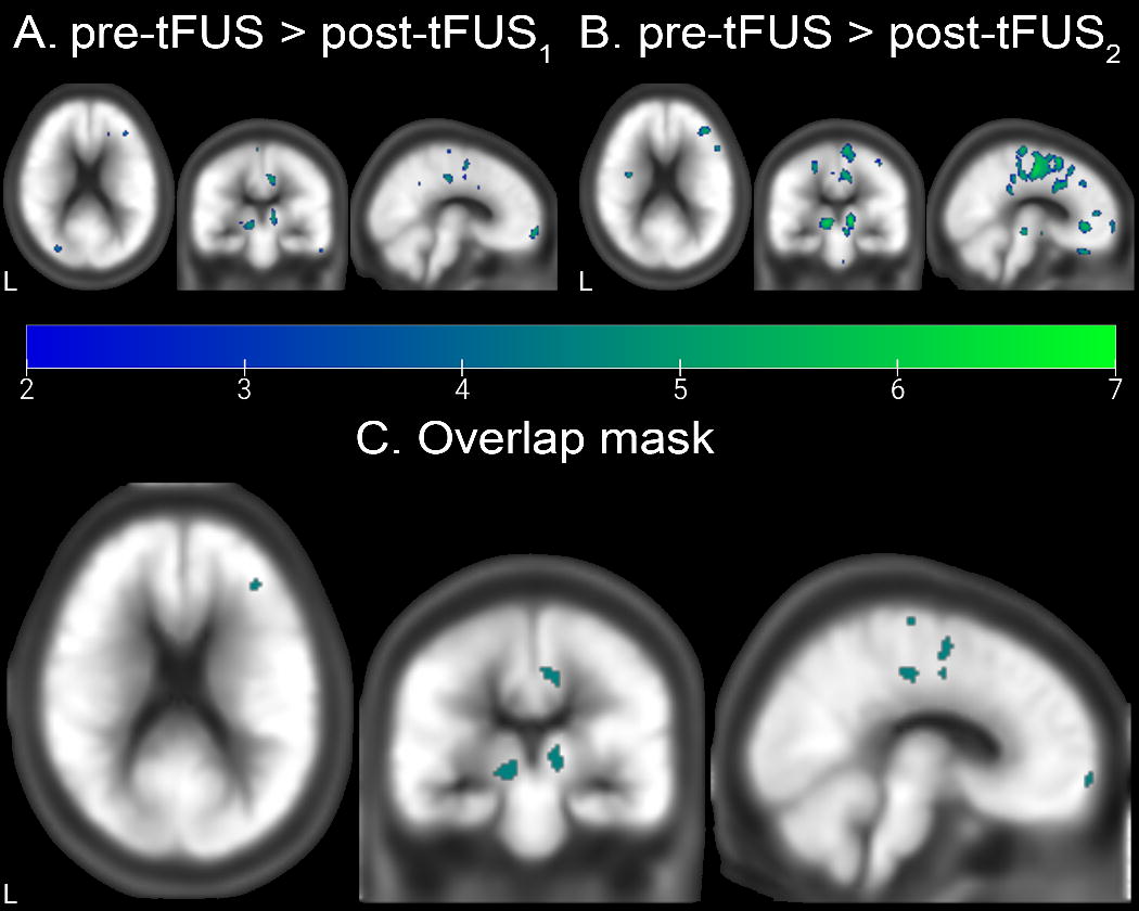 PET imaging figure showing reduced glucose metabolism after thalamic sonication