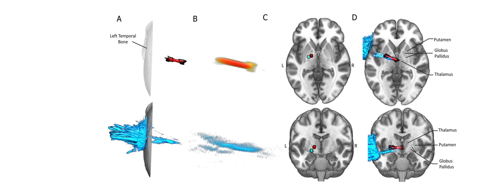 Acoustic simulation and anatomical targeting of the subcortical sonication